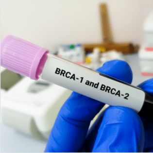 BRCA Gene Variants